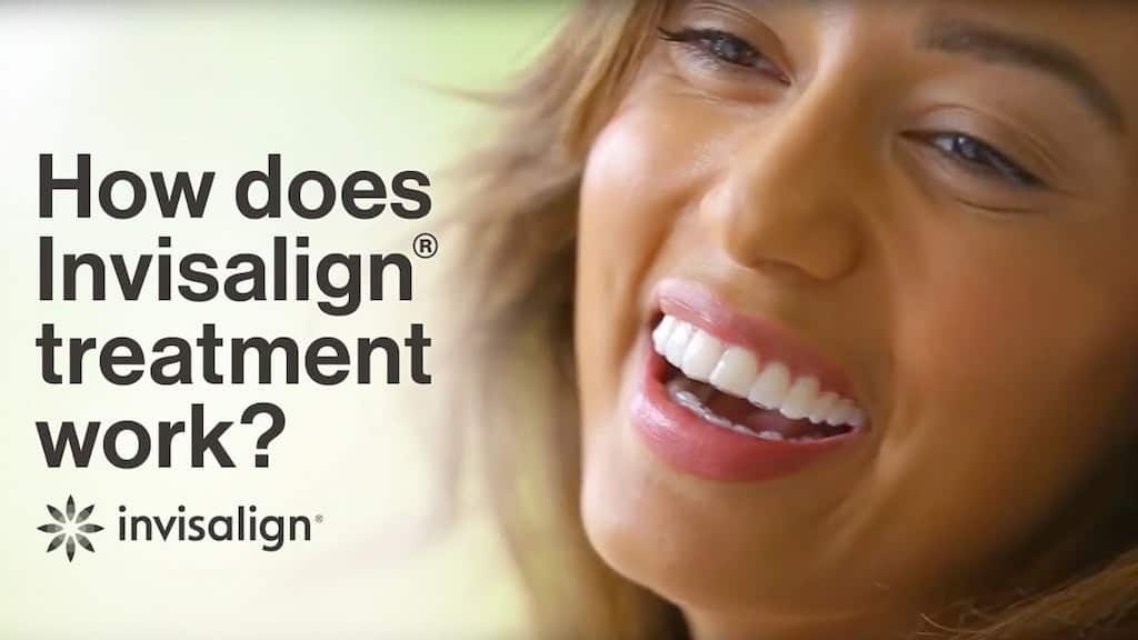invisalign how does it work appel orthodontics in how does invisalign work