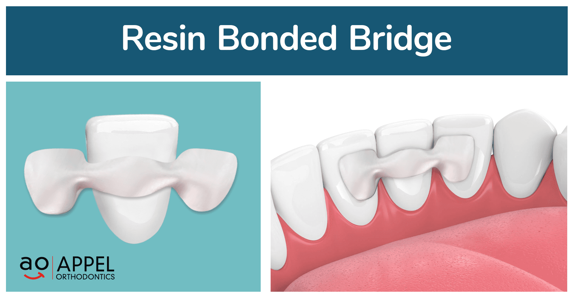 AO resinbondedbridge 03 - Missing Lateral Incisors? Help Your Smile With Braces!